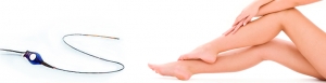 VENUS-Closure Radiofrequenz Behandlung
